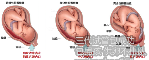 杭州捐卵价钱,河南试管婴儿费用明细：